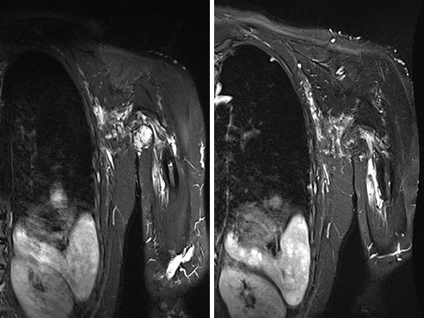 MRT – Die behandelten Anteile der lymphatischen Malformation sind stark geschrumpft