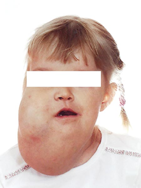 Lymphatische Malformation an Gesicht und Hals bei Kleinkind