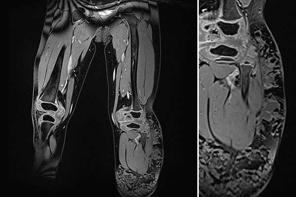 MRT – Kombinierte venolymphatische Malformation