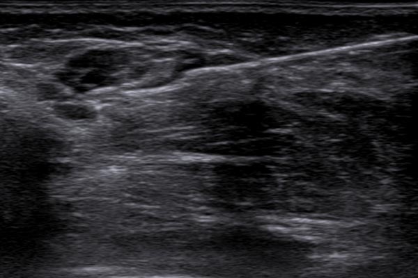 Biopsieentnahme – Kombinierte venolymphatische Malformation