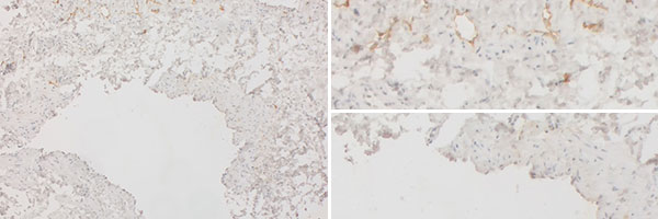 Immunhistologische Färbung – Kombinierte venolymphatische Malformation