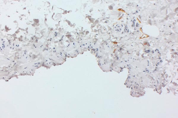 Immunhistologische Färbung – Kombinierte venolymphatische Malformation