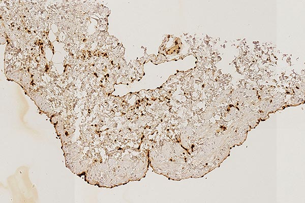 Immunhistologische Färbung – Kombinierte venolymphatische Malformation