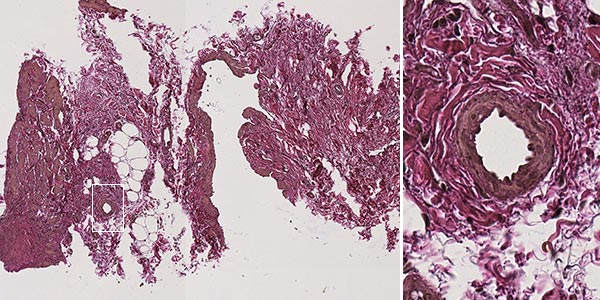 Immunhistologische Färbung – Kombinierte venolymphatische Malformation