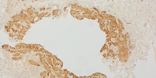 SMA-Färbung – Kombinierte venolymphatische Malformation