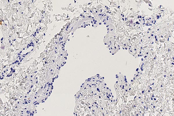 Ki67-Färbung – Kombinierte venolymphatische Malformation