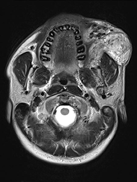 MRT – Arteriovenöse Malformation