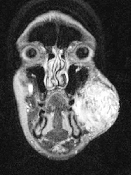 MRT – Arteriovenöse Malformation