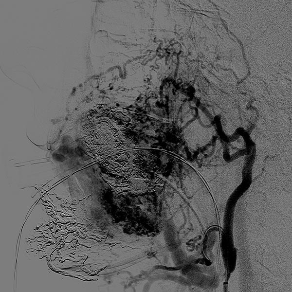 Ansicht einer Digitalen Subtraktionsangiographie