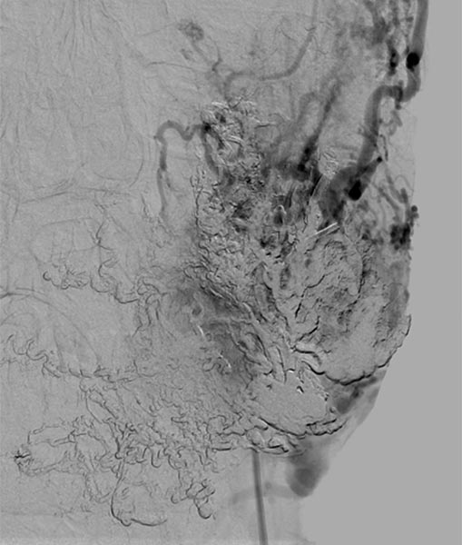 Digitale Subtraktionsangiographie – Punktion des Nidus