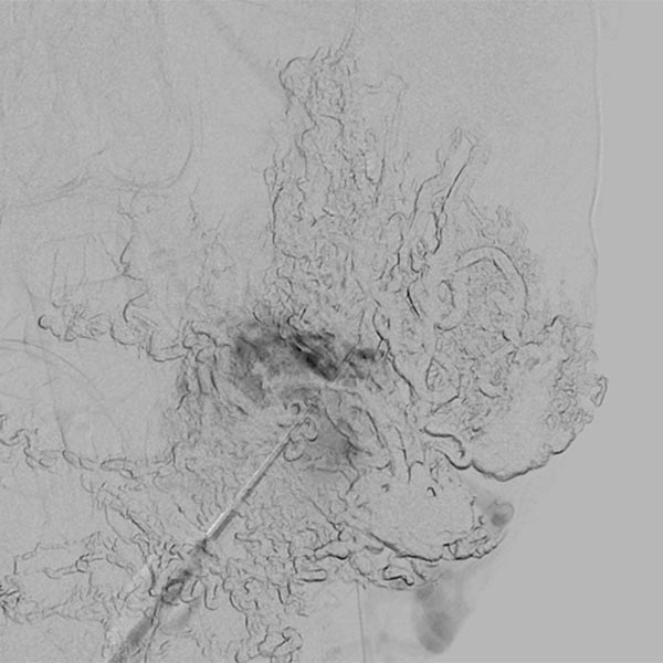 Digitale Subtraktionsangiographie – Punktion des Nidus