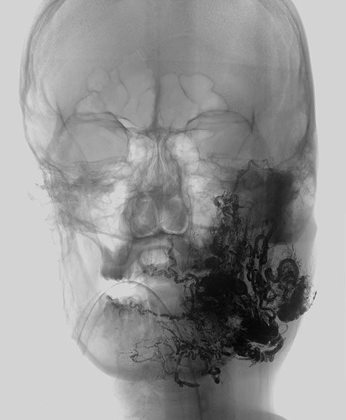 Röntgenbild – Embolisat bei AVM