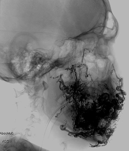 Röntgenbild – Embolisat bei AVM
