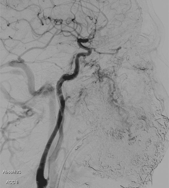 Digitale Subtraktionsangiographie – Punktion des Nidus