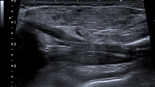 Sonographie – Subkutanes infantiles Hämangiom