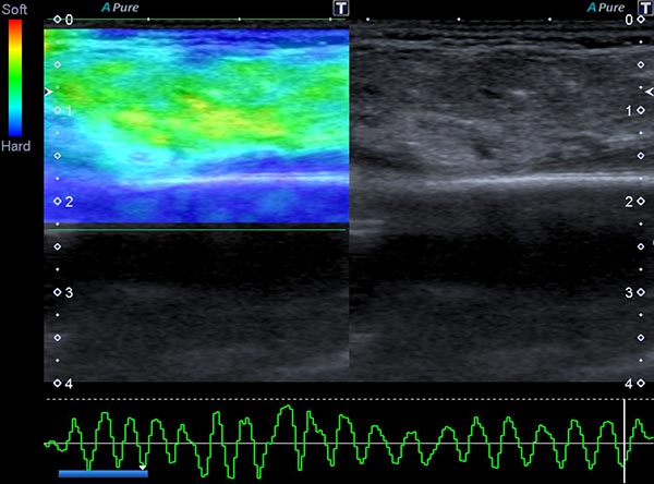 Ultraschall-Elastographie – Subkutanes infantiles Hämangiom