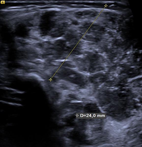 Sonographie – Subkutanes infantiles Hämangiom