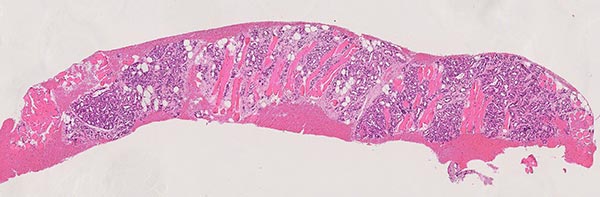 Histologie HE-Färbung – Subkutanes infantiles Hämangiom