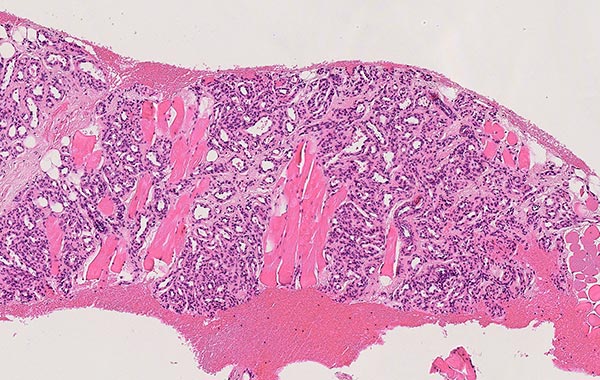 Histologie HE-Färbung – Subkutanes infantiles Hämangiom