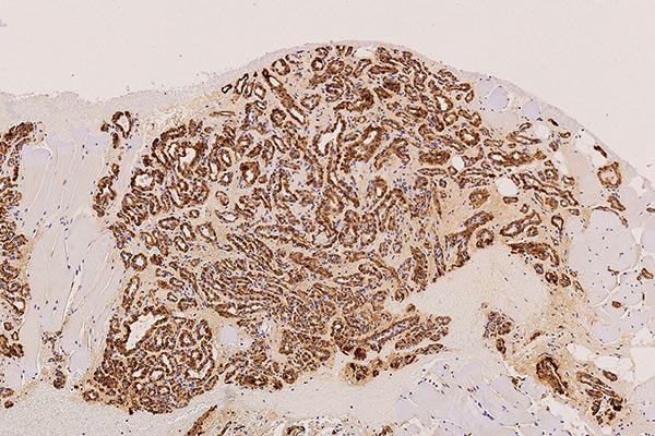 Histologie SMA – Subkutanes infantiles Hämangiom