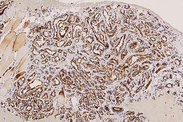 Histologie WT1-Färbung – Subkutanes infantiles Hämangiom