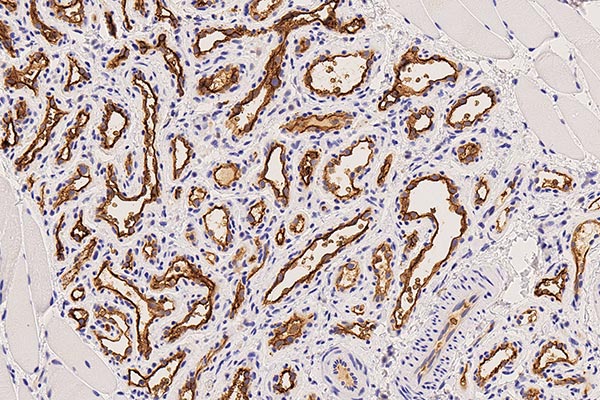 Histologie GLUT1-Färbung – Subkutanes infantiles Hämangiom