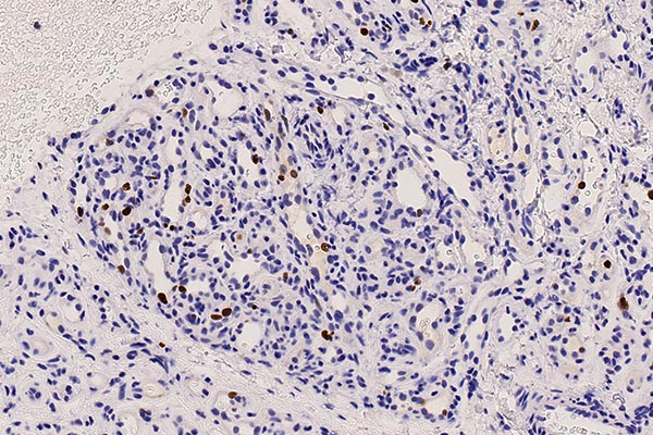 Histologie Ki67 – Subkutanes infantiles Hämangiom