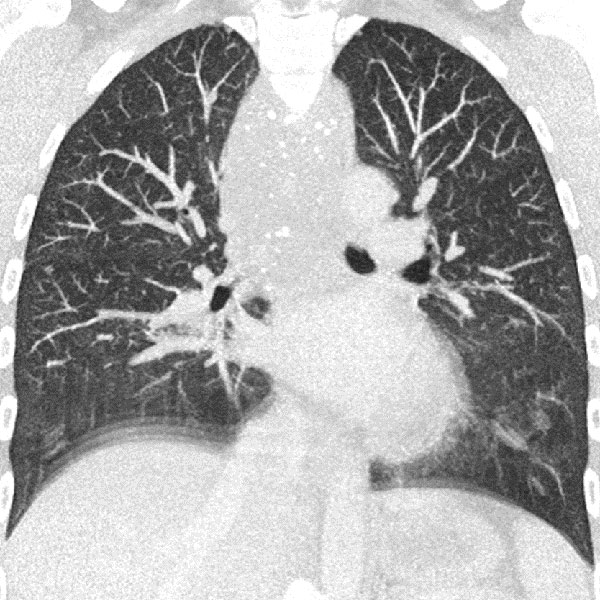 CT – Obstruktion der oberen Atemwege