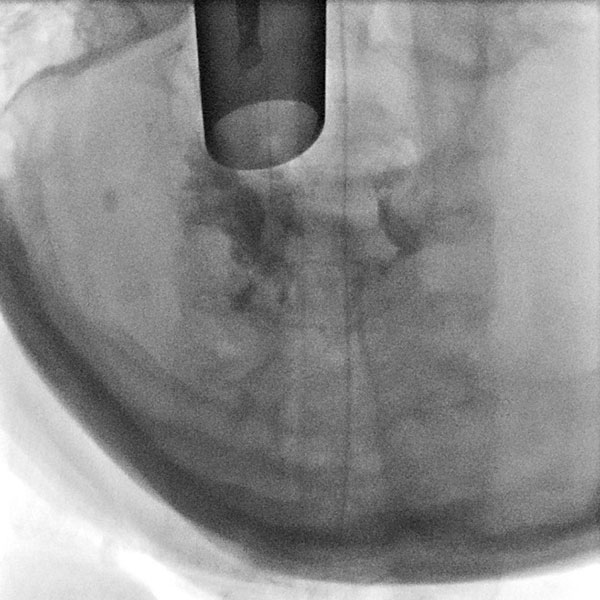 Sklerosierung – Obstruktion der oberen Atemwege