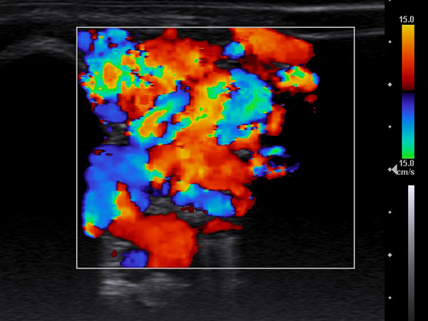 FKDS – Arteriovenöse Malformation an Hals/Thorax