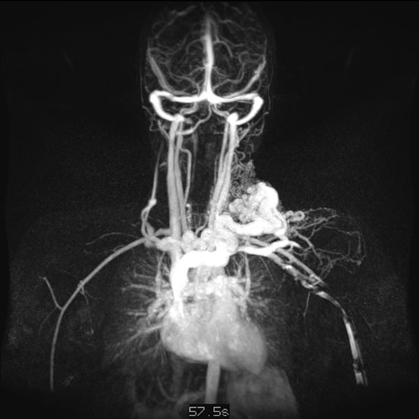 MR-Angiographie – Arteriovenöse Malformation an Hals/Thorax