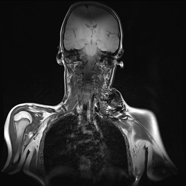 MR-Angiographie – Arteriovenöse Malformation an Hals/Thorax