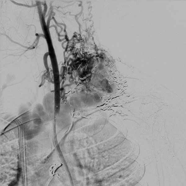 DSA – Arteriovenöse Malformation an Hals/Thorax