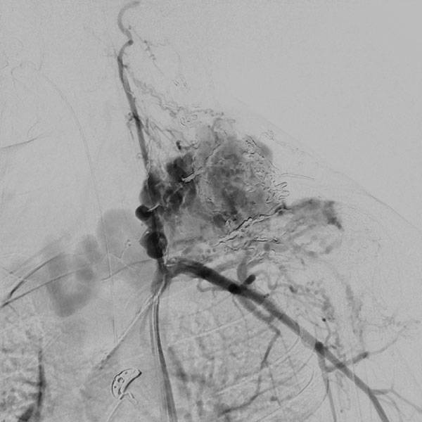 DSA – Arteriovenöse Malformation an Hals/Thorax