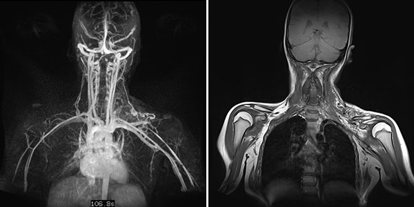 MR-Angiographie/MRT – Arteriovenöse Malformation an Hals/Thorax