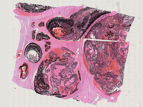 Histopathologie HE – Arteriovenöse Malformation an Hals/Thorax