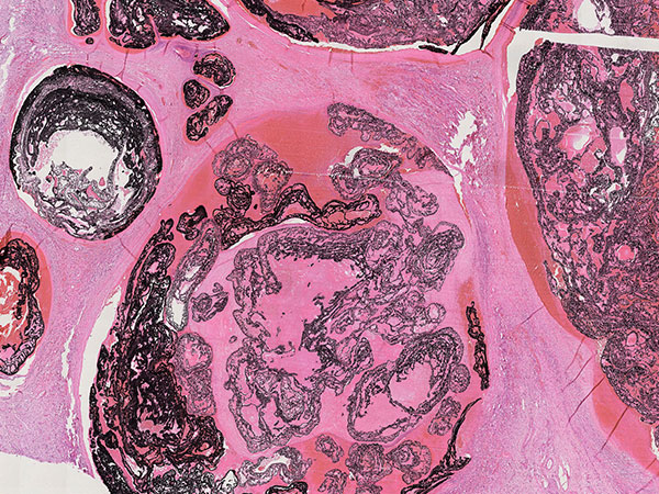 Histopathologie HE – Arteriovenöse Malformation an Hals/Thorax