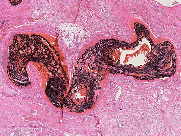 Histopathologie HE – Arteriovenöse Malformation an Hals/Thorax