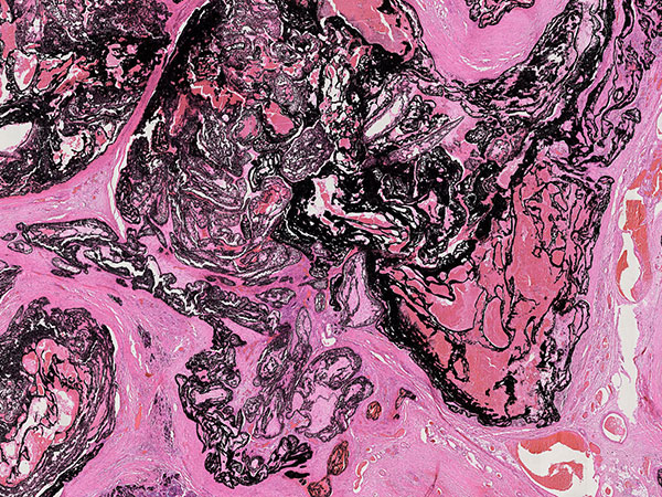 Histopathologie HE – Arteriovenöse Malformation an Hals/Thorax