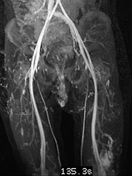 MRT – Genitale venöse Malformation am Labium majus