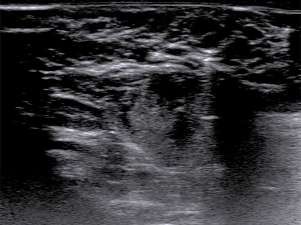 Sonographie – Genitale venöse Malformation am Labium majus