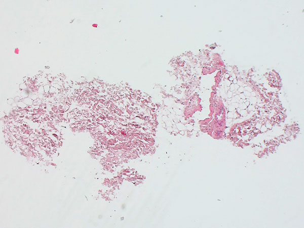 Histopathologie (HE) – Genitale venöse Malformation am Labium majus