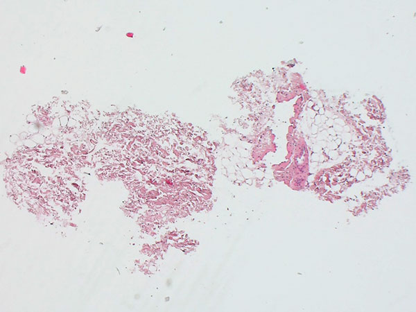 Histopathologie (HE) – Genitale venöse Malformation am Labium majus