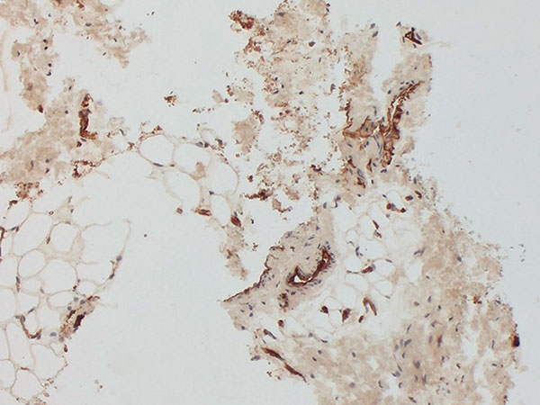 Histopathologie – Genitale venöse Malformation am Labium majus