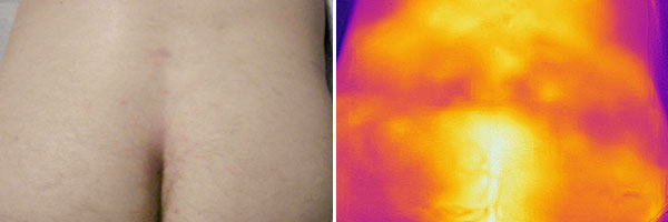 Infrarotthermographie  – Intramuskuläre venöse Malformation