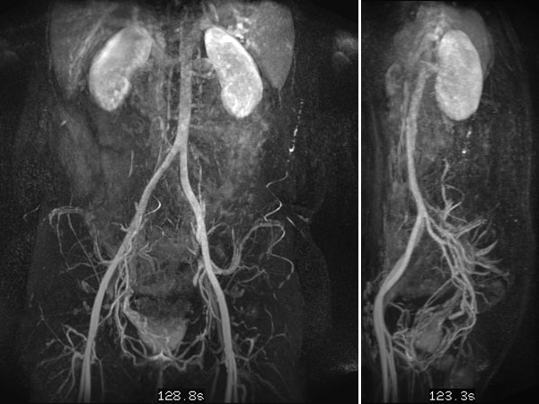 MR-Angiographie  – Intramuskuläre venöse Malformation