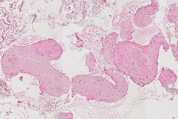 Histopathologie HE-Färbung – Intramuskuläre venöse Malformation