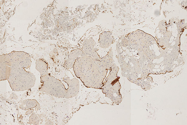 Histopathologie CD31-Färbung – Intramuskuläre venöse Malformation