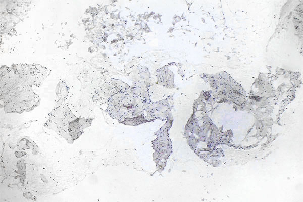 Histopathologie Ki67-Färbung – Intramuskuläre venöse Malformation