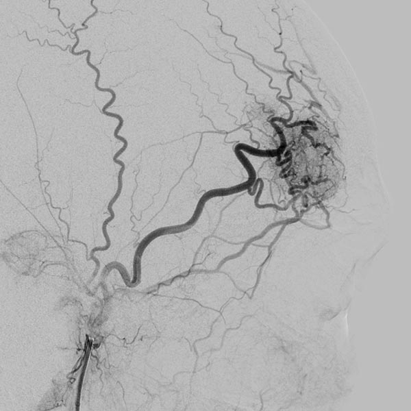 Digitale Subtraktionsangiographie – Stirn